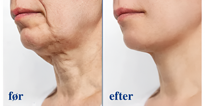 SkinFirm® | Opstrammende & Rynke-reducerende Creme